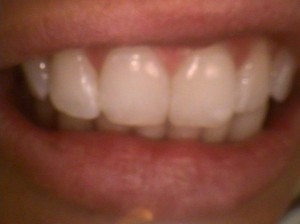 Repaired tooth